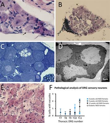 NOD mouse dorsal root ganglia display morphological and gene expression defects before and during autoimmune diabetes development